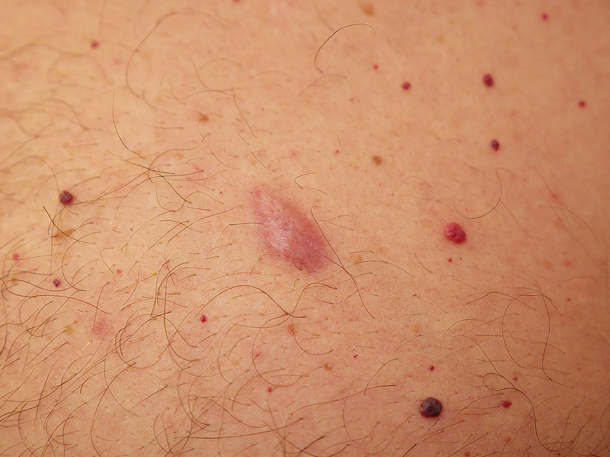 Common lumps and bumps on and under the skin: what are they? - Dermatology Research - University of Queensland