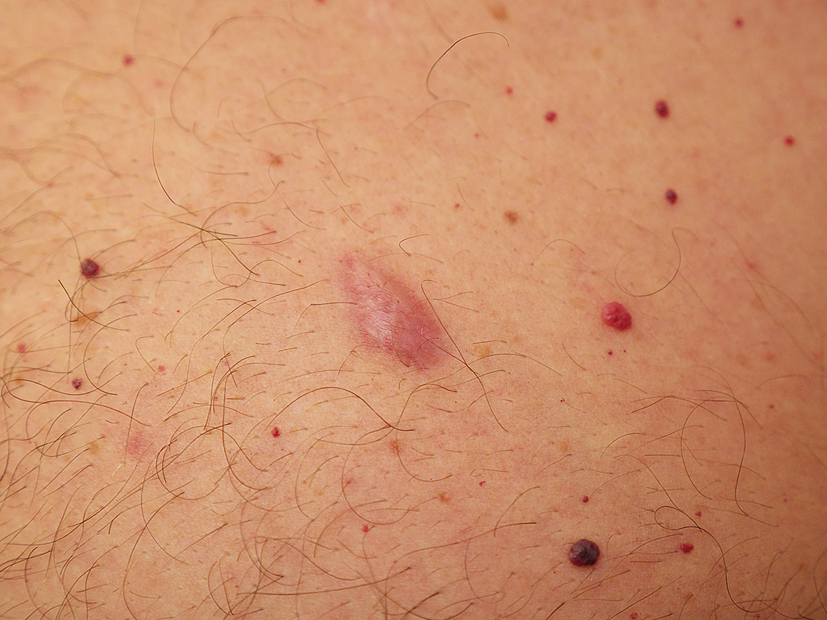 Little Lumps Under Skin On Chest Online | cdlguaiba.com.br