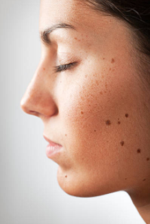 Moles on face