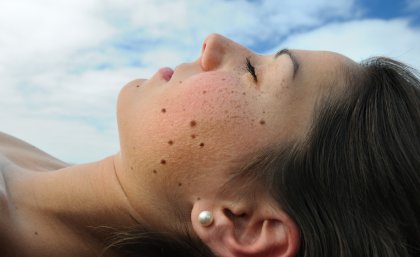 Lady with moles on side of face