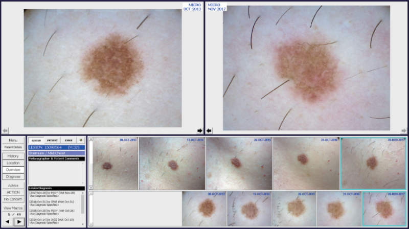 Sequential digital dermoscopy of a naevus