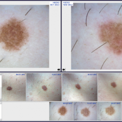 Sequential digital dermoscopy of a naevus