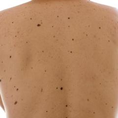 Moles on back