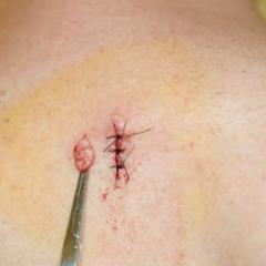 Skin biopsy