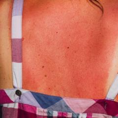 Sunburnt back