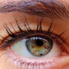 Freckles in iris