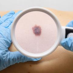 Dermatologist looking at a mole