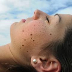 Lady with moles on side of face