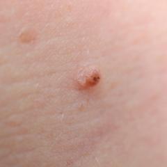 Pale melanomas masked by albino gene