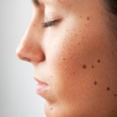 Moles on the face