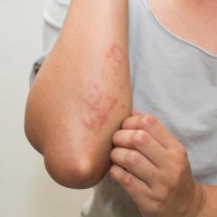Skin rash near elbow